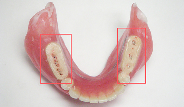診断用義歯2